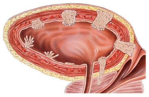 Những người có khối u ở vị trí này, 90% sẽ mắc ung thư